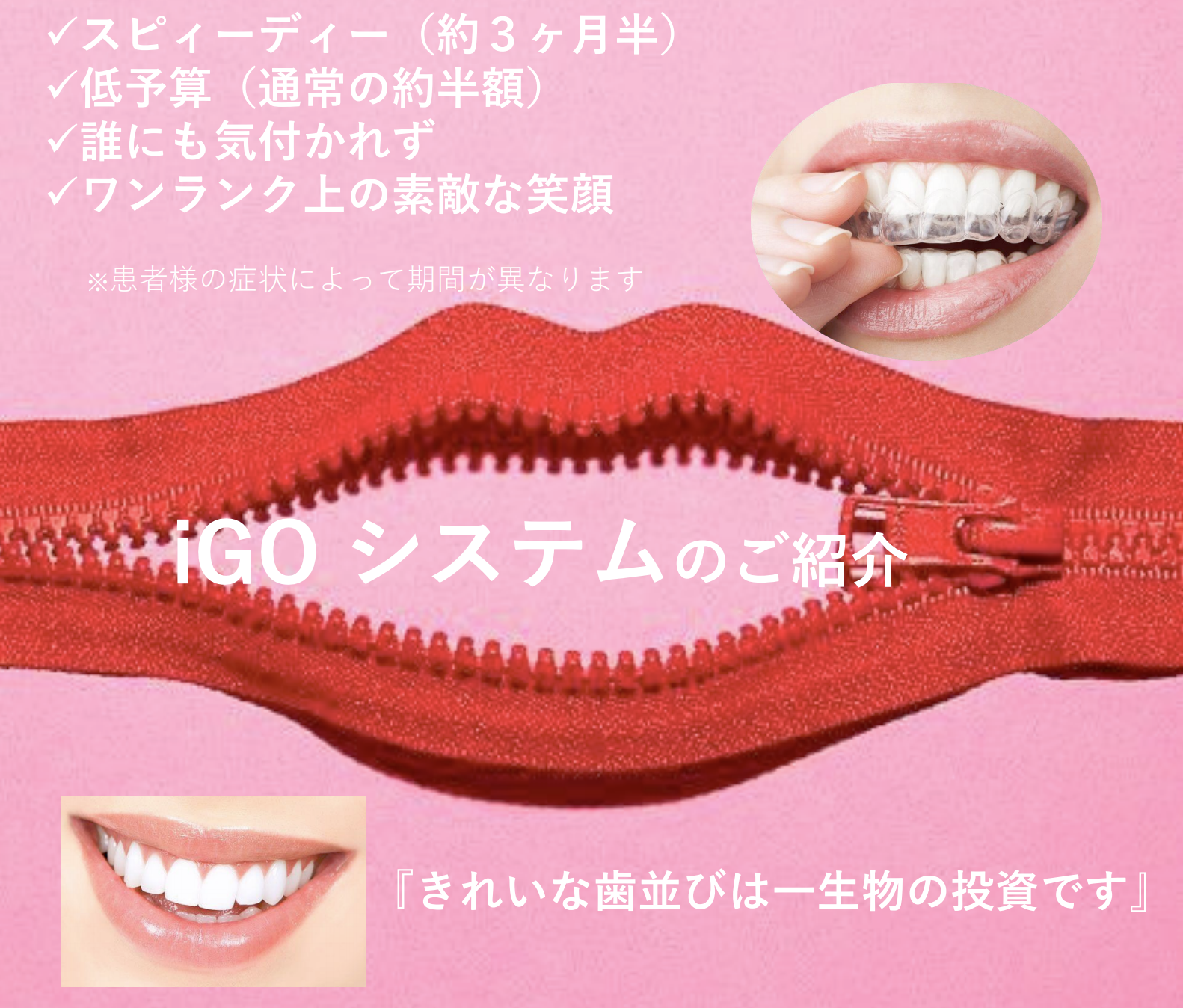 インビザラインGO マウスピース矯正